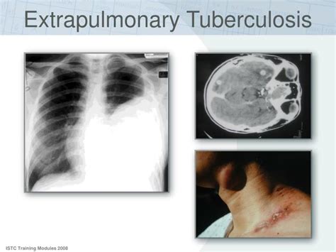 PPT - Clinical Presentation and Diagnosis of Tuberculosis PowerPoint ...