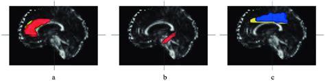 MRI images with ROIs marked. A: anterior cingulate gyrus, B: posterior... | Download Scientific ...