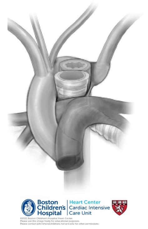 Right Aortic Arch With Aberrant Left Subclavian