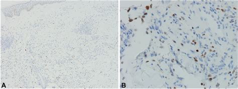 Kaposi Sarcoma In A Men Who Have Sex With Men Patient Without Human