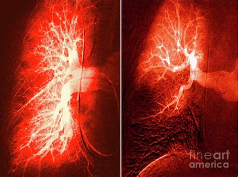 Pulmonary Embolism And Healthy Lung Photograph By Zephyrscience Photo Library Pixels