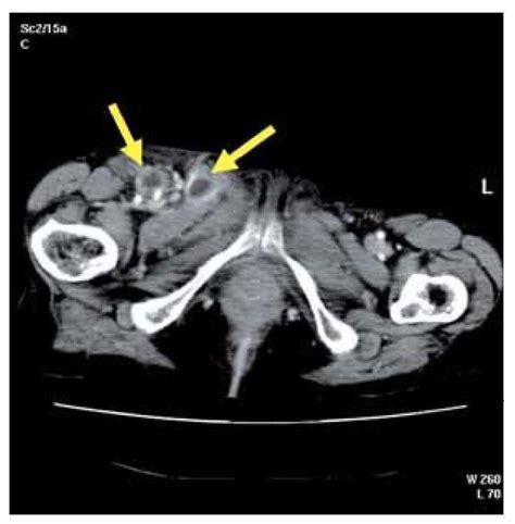 Inguinal Abscess