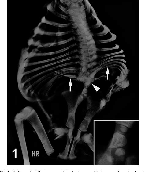 Figure From Perosomus Elumbis Cerebral Aplasia And Spina Bifida In