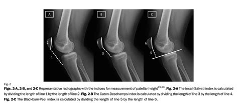 Patellar Dislocation Introduction And Diagnosis Sports Medicine Review