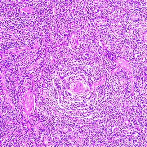 Plasma Cell Type Unicentric Castleman Disease Hematoxylin Eosin Download Scientific Diagram