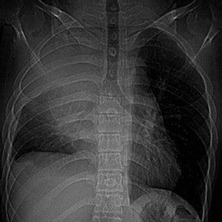 Chest X Ray Posterior Anterior View Showing Rightsided Homogeneous