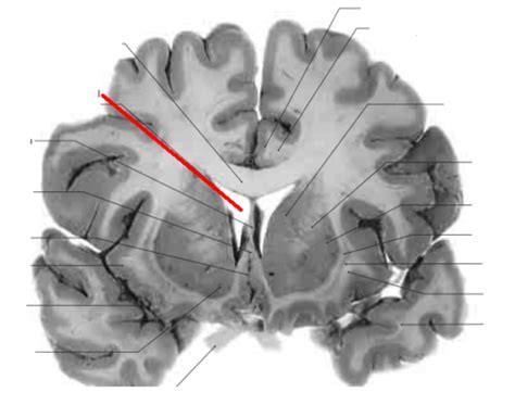 Coronal Cut Brain Pictures Flashcards Quizlet