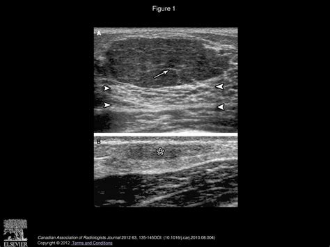 Imaging Of Fibroepithelial Lesions A Pictorial Essay Ppt Download
