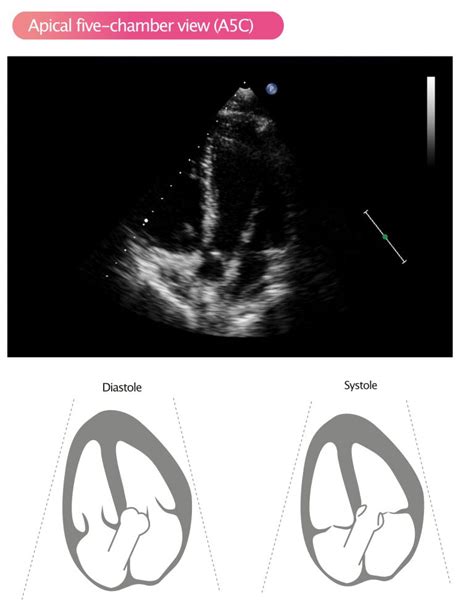 Standard Transthoracic Echocardiogram Complete Imaging Protocol Ecg