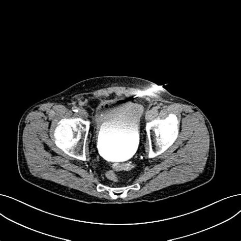 File Chronic Appendicitis Complicated By Appendicular Abscess