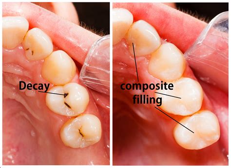 Composite Fillings Brea Ca Santa Rosa Dental Office