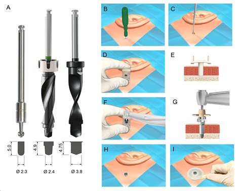 Figure From Ex Vivo Evaluation Of A New Drill System For Placement Of