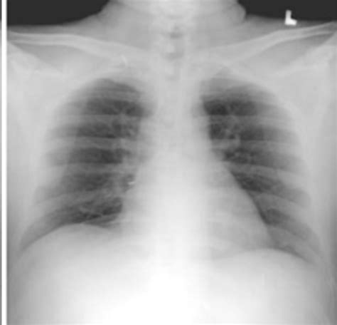 Radiology Chest X Ray Flashcards Quizlet