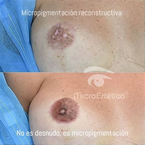 Micropigmentaci N De Areolas M Laga Quimioterapia