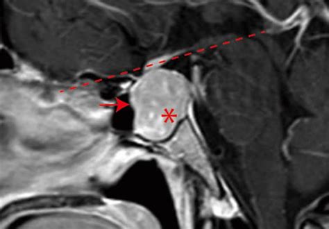 Elucidating A Rare Pituitary Cancer Mayo Clinic