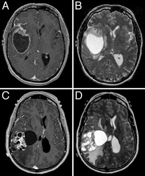 A Critical Evaluation Of Cystic Features In Primary Glioblastoma As A