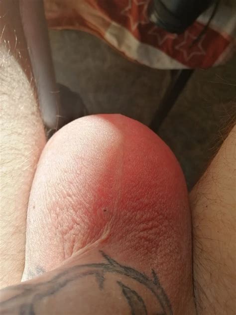 Saline Infusion Scrotum And Titti L Nude Pics XHamster