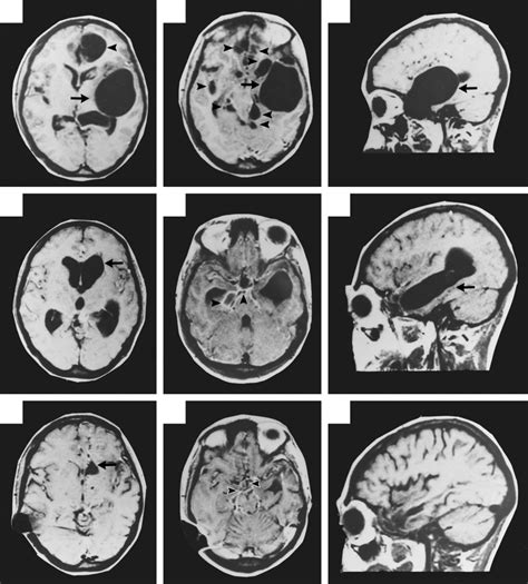 Gadolinium Enhanced Spin Echo T Weighted Mri Scans Of Patient