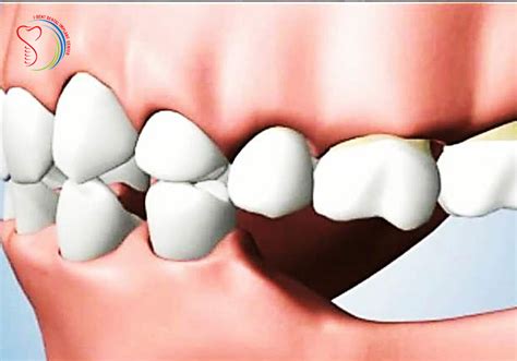 Missing Teeth Number And The Dangerous Consequences Of Tooth Loss