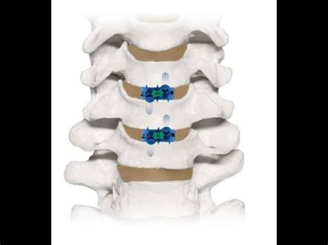 Cirurgia De Coluna Cervical Anterior Material Coalition Globus