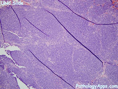 Small Cell Carcinoma Lung Histology