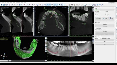 Blue Sky Bio Cbct Implant Planning Part Registeration Of Cbct