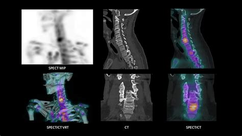 Spect Ct In Musculoskeletal Medicine Siemens Healthineers Usa