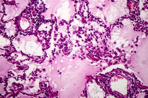 Lung Adenocarcinoma Stock Image Image Of Tumour Microscopy 130900741