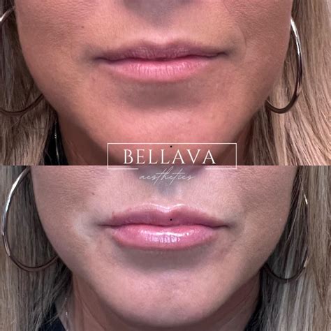 Lip Filler Results Before And After In Crestview Hills Ky