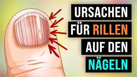 WAHREN Ursachen für vertikale Rillen auf deinen Nägeln YouTube