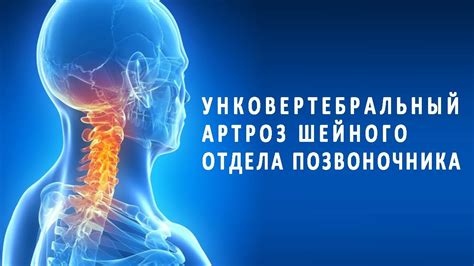 Унковертебральный (деформирующий) артроз шейного отдела позвоночника ...