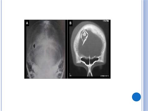 PROYECCIONES RADIOLOGICAS DE CRANEO Pptx