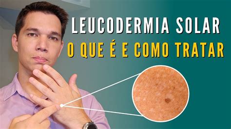 Manchas Brancas Na Pele Leucodermia Solar Saiba Como Tratar Youtube