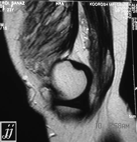 Quadriceps Muscle Problem Radiopaedia