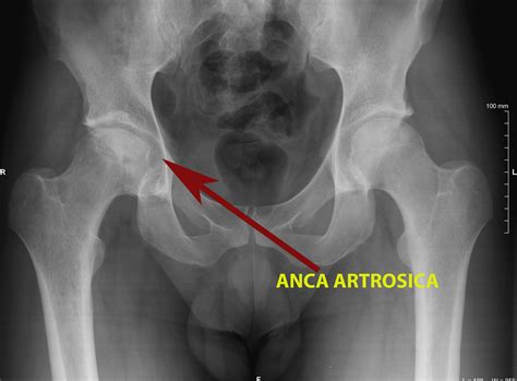 Artrosi Dell Anca Coxartrosi Quali Sono I Sintomi E Quali Le Cure