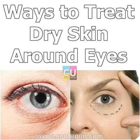 10 Ways To Treat Dry Skin Around Eyes Dry Skin Around Eyes Dry Facial Skin Remedies