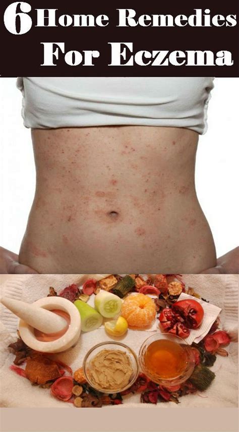 6 Home Remedies For Eczema | Home remedies for eczema, Eczema remedies ...