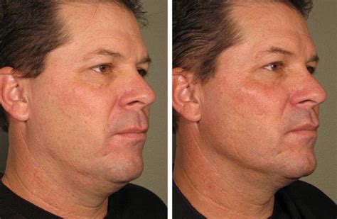 Ultherapy Before After Fairfax Va Impressions Medspa