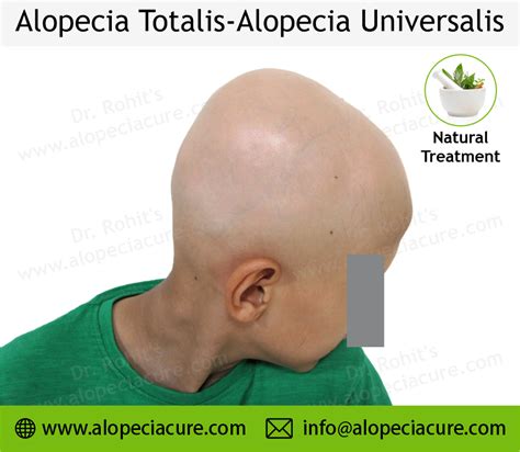 Alopecia Universalis