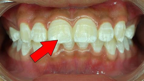 Ways To Get Rid Of White Spots On Teeth Youtube