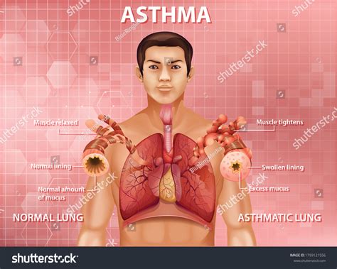 Human Anatomy Asthma Diagram Illustration Stock Vector Royalty Free