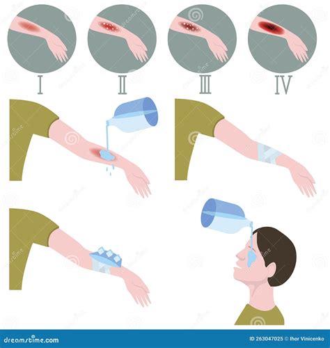 Burn Stages First Aid For Thermal Injuries Of The Body And Fires Stock