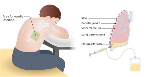 Pleural Effusion Pleural Effusion Antibiotics For Pneumonia Treatment ...