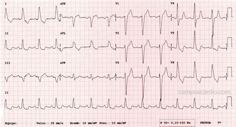 Caso clínico Electrocardiograma 86 con insuficiencia cardíaca crónica