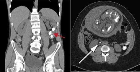 CT KUB Scan: Price, Purpose, Procedure, & Contrast [2025]