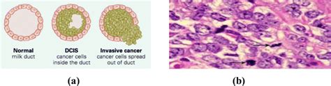 Invasive Ductal Carcinoma Idc 3 A Cancer Cell In Ducts B