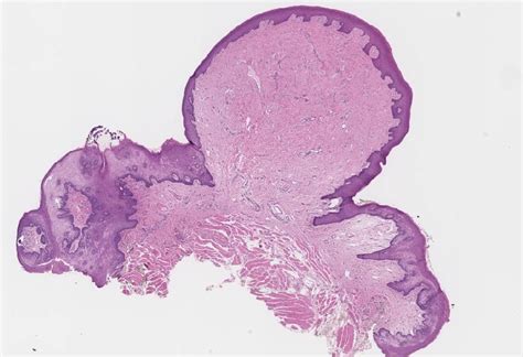 Irritation Fibroma Histology