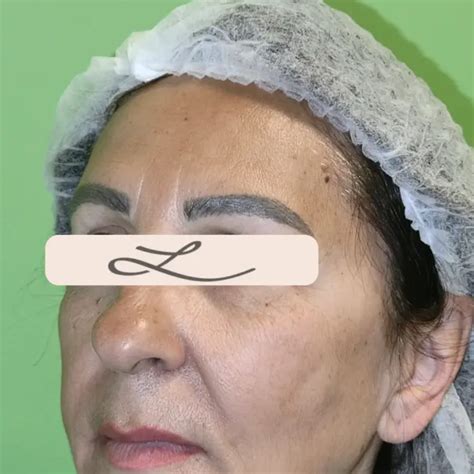 Lifting Facial Chirurgical Gât și Sprâncene Dr Lazar