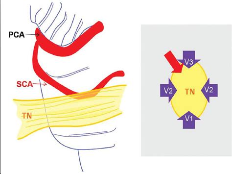 Figure 14 from Imaging in neurovascular conflict of the trigeminal ...