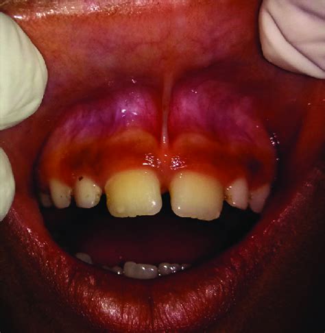 Preoperative View Showing Aberrant Labial Frenulum With Midline